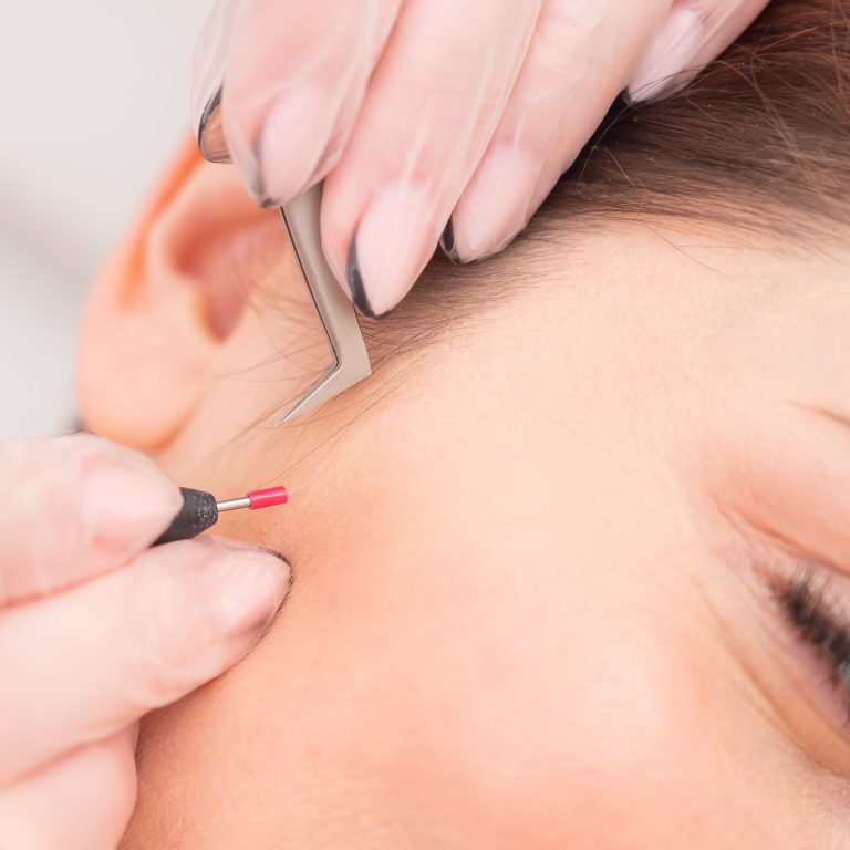 Woman on electro-epilation of the face. Hardware permanent removal of unwanted hair in the salon.
